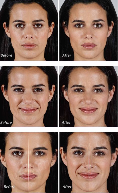 Bad Nasolabial Fold Filler: The Pitfalls, How to Avoid Them