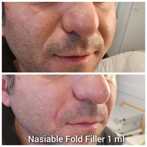 Bad Nasolabial Fold Filler: The Pitfalls, How to Avoid Them