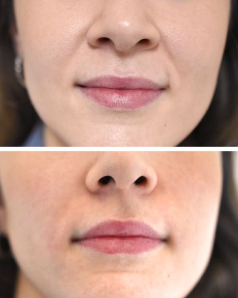 Bad Nasolabial Fold Filler: The Pitfalls, How to Avoid Them