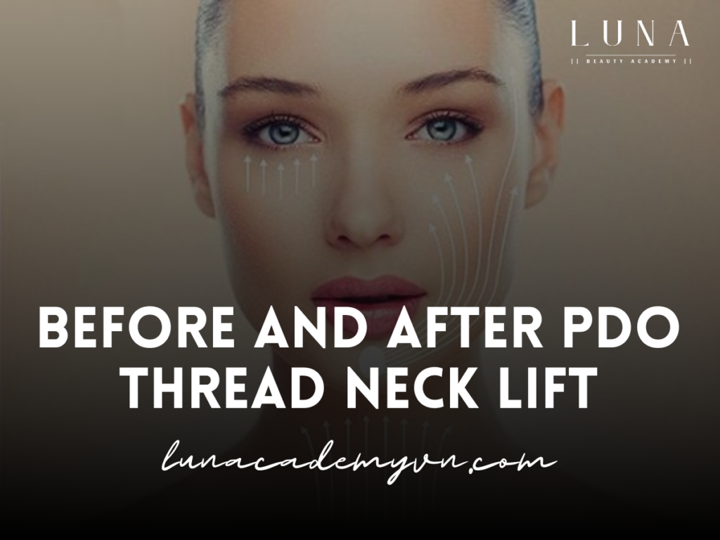 Before and After PDO Thread Neck Lift