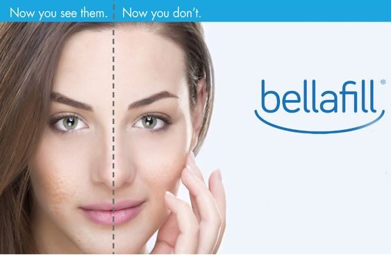 Bellafill PMMA Filler