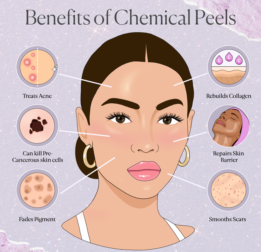 Benefits of Chemical Peels 