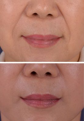 Best Filler for Nasolabial Folds