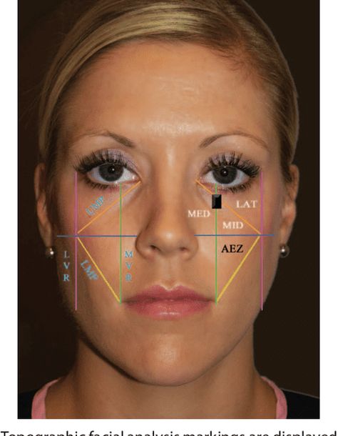 Best Filler for Nasolabial Folds