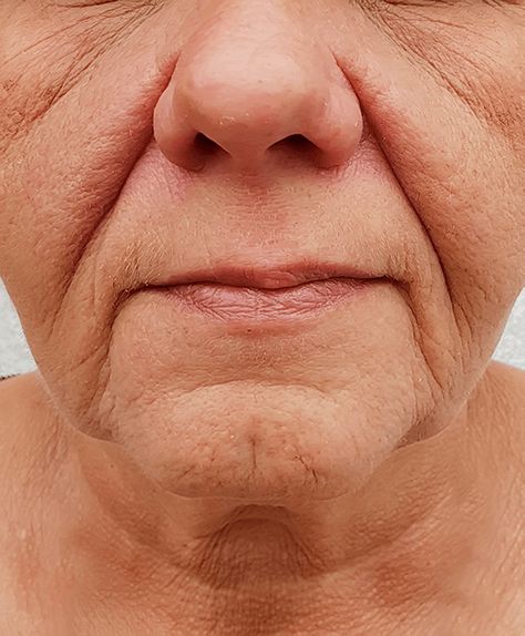 Best Filler for Nasolabial Folds