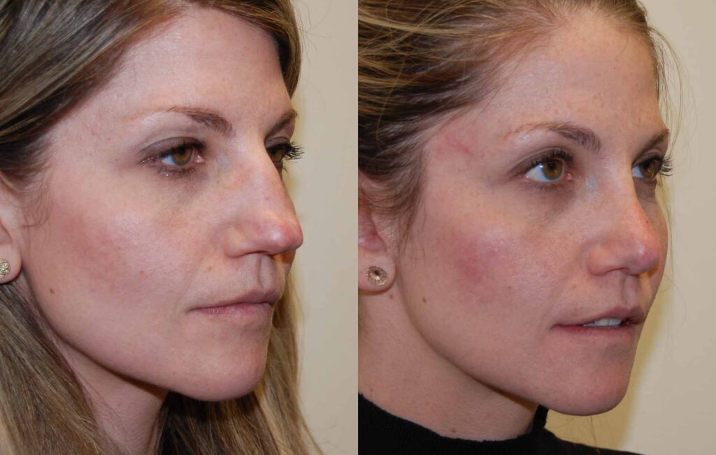  Bifid Nose Tip Filler Can Improve Nose Symmetry