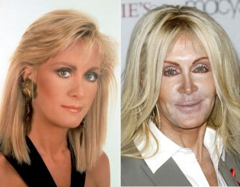 Botched Celebs: Celebrities Who Took Plastic Surgery Too Far