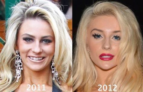 Botched Celebs: Celebrities Who Took Plastic Surgery Too Far