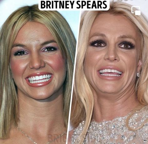 Botched Celebs: Celebrities Who Took Plastic Surgery Too Far