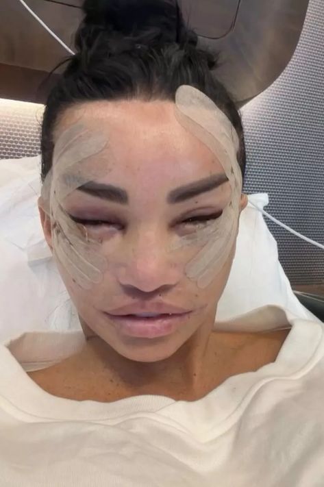 Botched Celebs: Celebrities Who Took Plastic Surgery Too Far