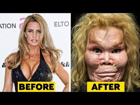 Botched Celebs: Celebrities Who Took Plastic Surgery Too Far