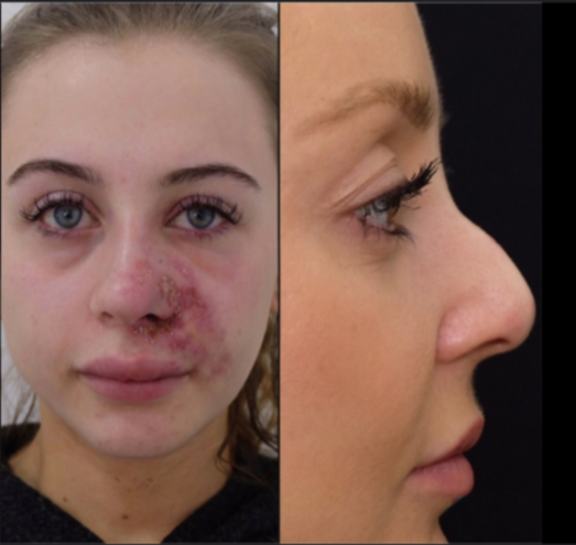 Botched Face Fillers: The Risks and How to Avoid Them