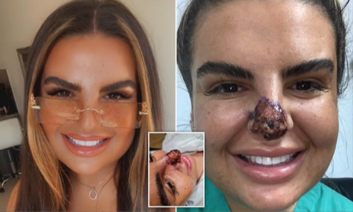 Botched Face Fillers: The Risks and How to Avoid Them