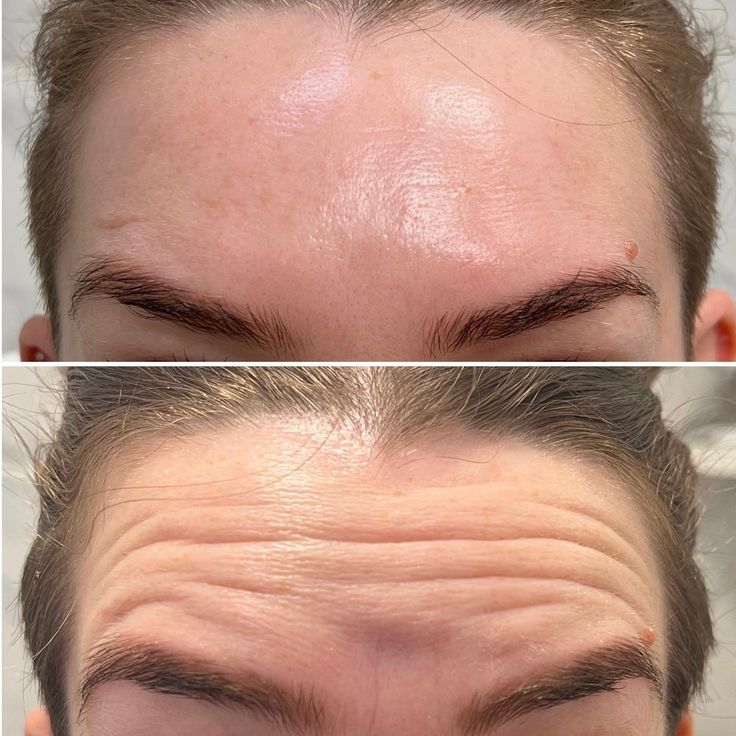 Botox for Oily Skin Before and After