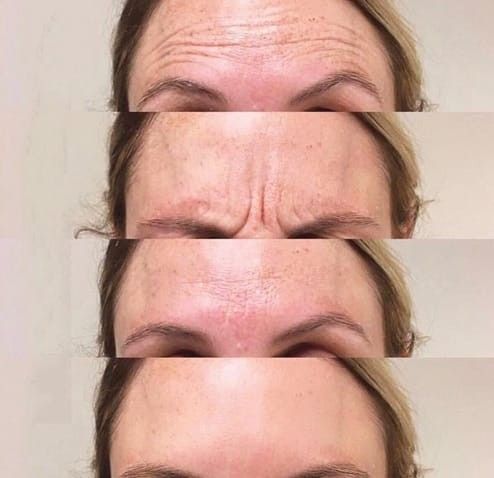 Botox for the Forehead Result 