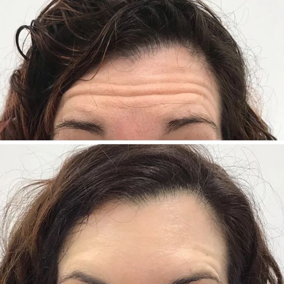 BOTOX Horizontal Forehead Lines