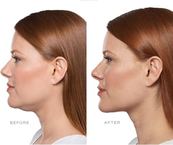 Botox in Jawline Before and After