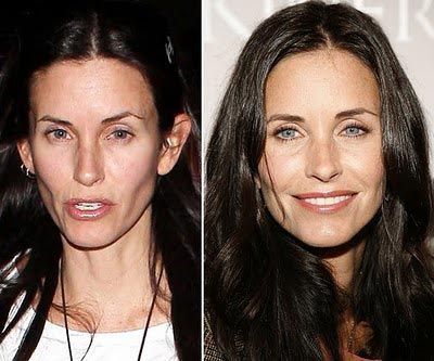 Botox Pictures Gone Wrong: What You Need to Know