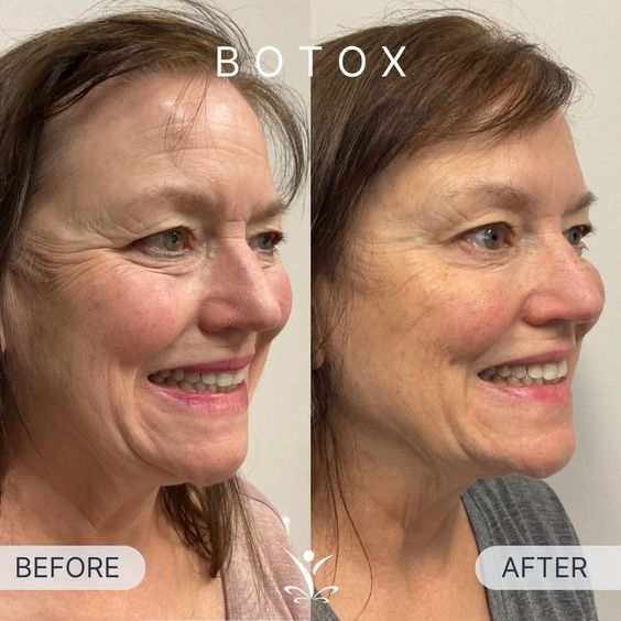 Botox Reducing Smile Lines