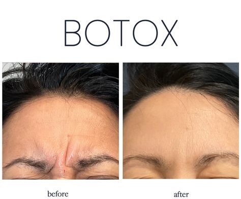 Botox Syringes with Needles: Choosing the Right Tools