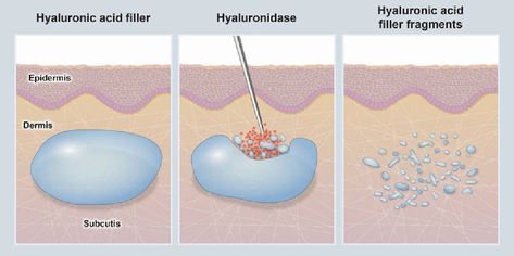 Breast Filler Injection Cost: What to Expect