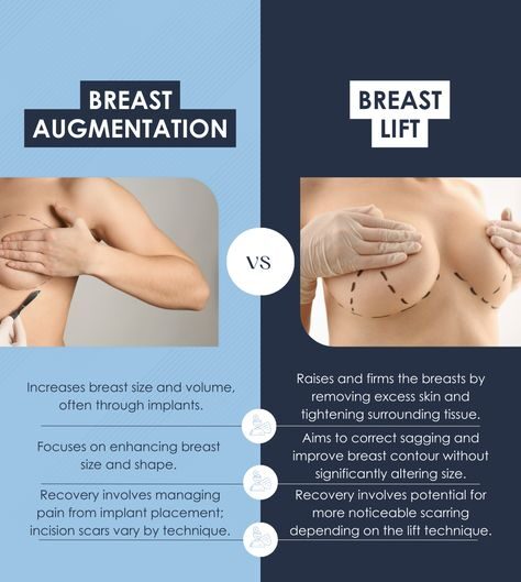 Breast Lift Using Threads: A Revolutionary Approach to a Natural Lift