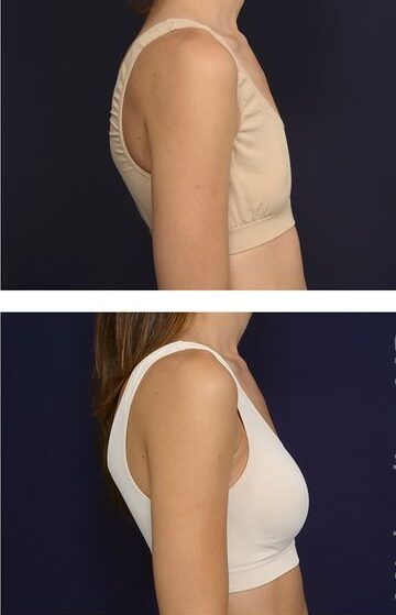 Breast Lift Using Threads: A Revolutionary Approach to a Natural Lift