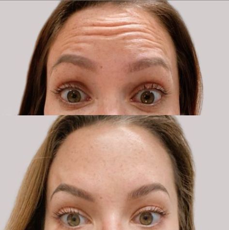 Brow Lift Filler: A Comprehensive Guide