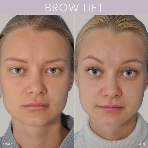 Brow Lift Filler: A Comprehensive Guide