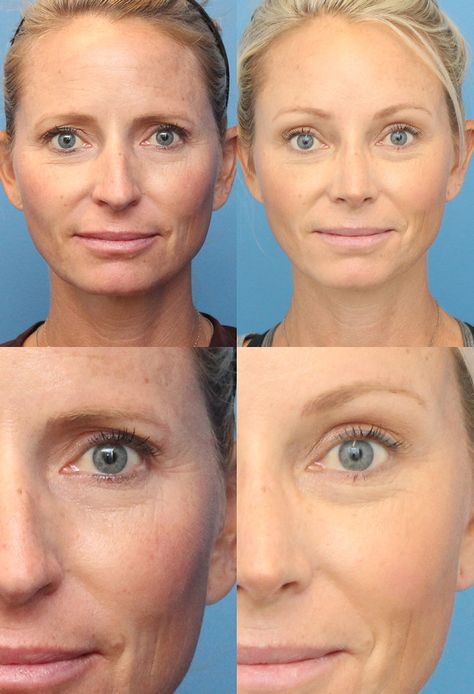 Brow Lift Filler: A Comprehensive Guide