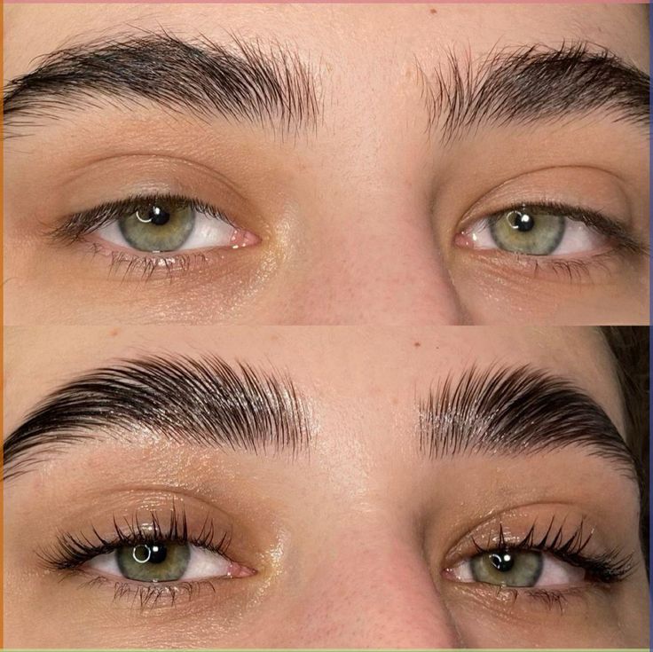 Brow Lift Filler: A Comprehensive Guide