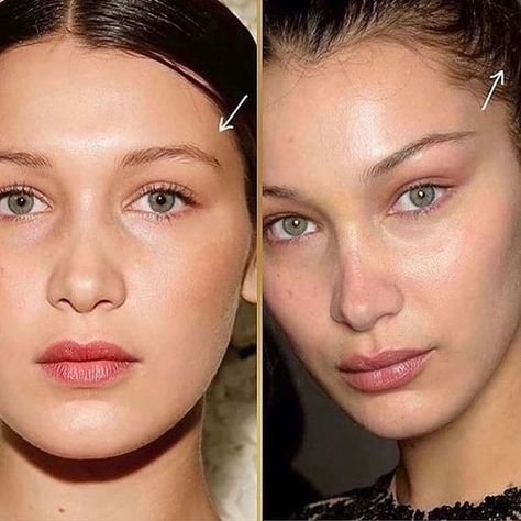 Brow Lift Filler: A Comprehensive Guide