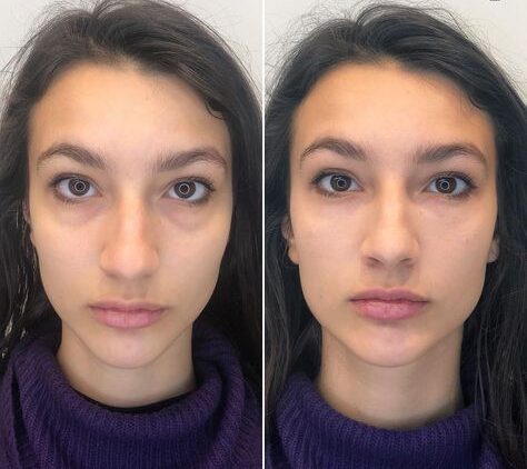 Brow Lift Filler: A Comprehensive Guide