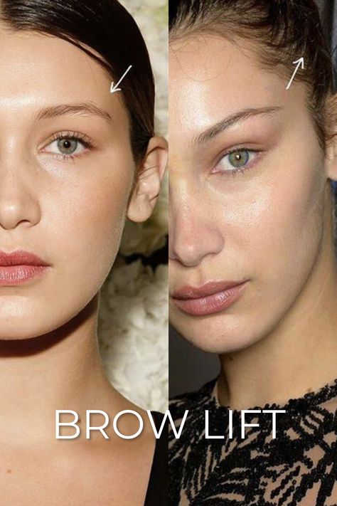 Brow Lift with Filler: Enhancing Your Look with Non-Surgical 