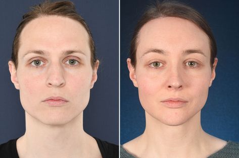 Brow Lift with Filler: Enhancing Your Look with Non-Surgical 