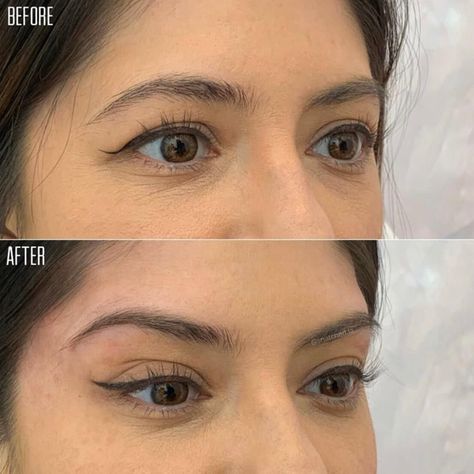 Brow Lift with Filler: Enhancing Your Look with Non-Surgical 