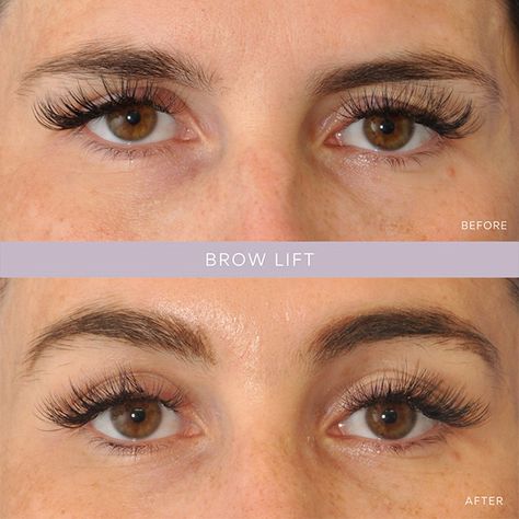 Brow Lift with Filler: Enhancing Your Look with Non-Surgical 