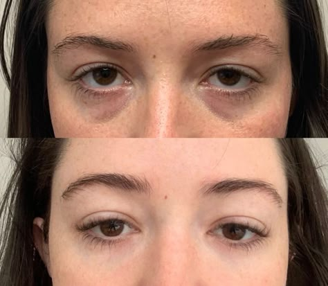 Brow Thread Lift Before and After