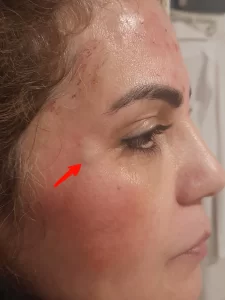 Bruising, or mild swelling after injection botox