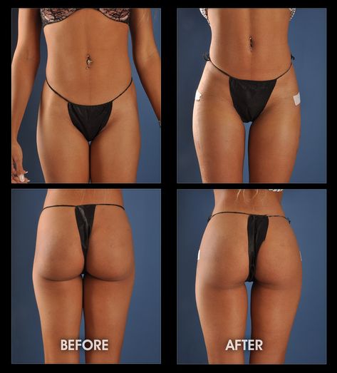 Buttock Augmentation Philippines Cost