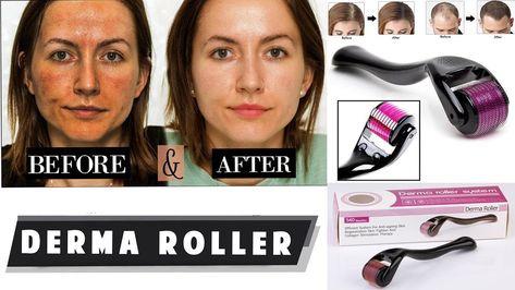 Can We Use Derma Roller Daily for Hair Growth?