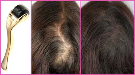 Can You Use Minoxidil After Dermarolling?