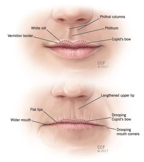 Cannula Filler Before and After: A Comprehensive Overview