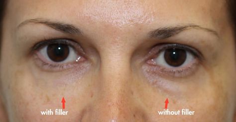 Cannula Under Eye Filler: Safe and Effective Treatments