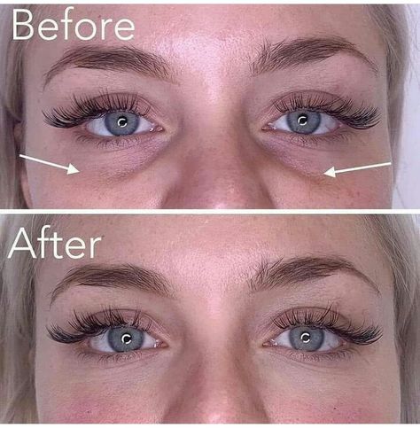 Cannula Under Eye Filler: Safe and Effective Treatments