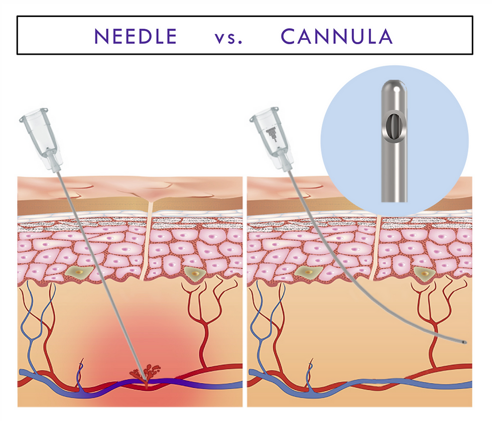 Cannula vs Neesle injection