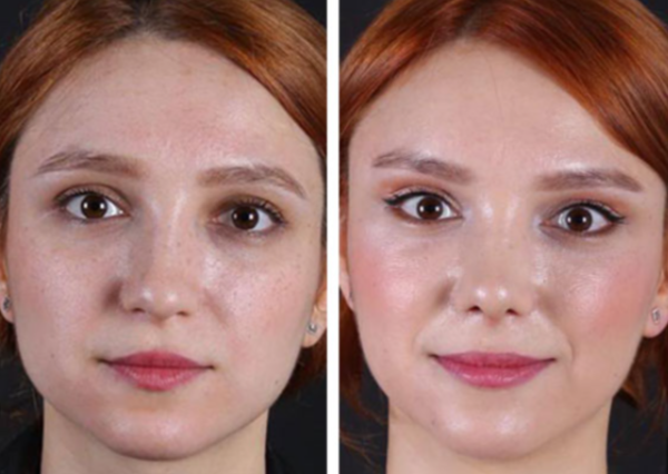 Cat Eye Face Lift: Achieving a Lifted, Alluring Look