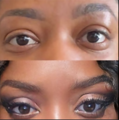 Cat Eye Face Lift: Achieving a Lifted, Alluring Look