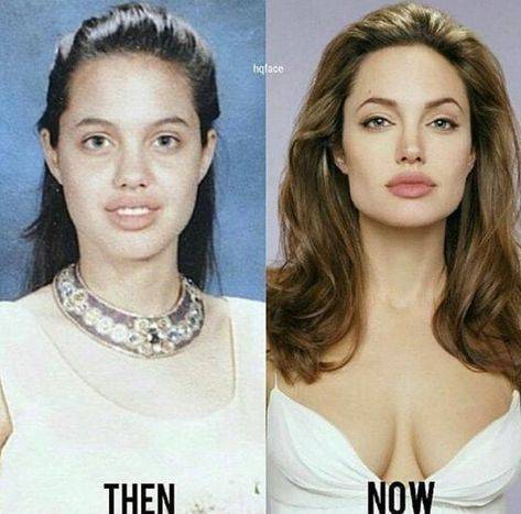 celebrities before and after lip fillers