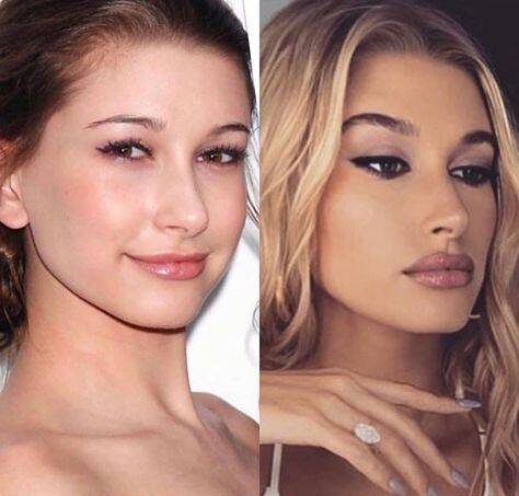 celebrities before and after lip fillers